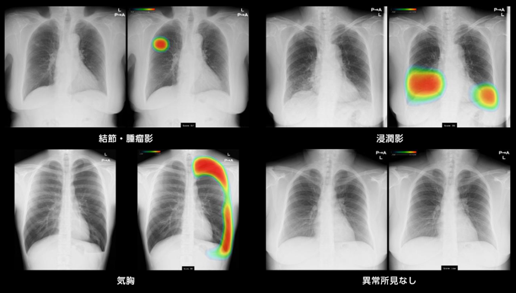 医師は結核を診断するために X 線を使用しますか?